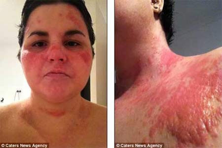 Da tấy đỏ hoặc bị sưng: Dị ứng thường làm da bị tấy đỏ hoặc sưng, nhất là khu vực quanh môi hoặc trên mặt. Các loại hải sản và trứng là những tác nhân dị ứng đôi khi gây ra những triệu chứng như thế này. Xem thêm:Điểm danh 12 loại rau, quả dễ nhiễm thuốc trừ sâu hàng đầu 2012 Da tấy đỏ hoặc bị sưng: Dị ứng thường làm da bị tấy đỏ hoặc sưng, nhất là khu vực quanh môi hoặc trên mặt. Các loại hải sản và trứng là những tác nhân dị ứng đôi khi gây ra những triệu chứng như thế này. Xem thêm:Điểm danh 12 loại rau, quả dễ nhiễm thuốc trừ sâu hàng đầu 2012