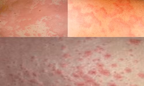 Nổi mề đay cấp tính là phản ứng dị ứng trên toàn cơ thể, gây khó thở do bị sưng nề đường thở và huyết áp giảm đột ngột do thành mạch máu bị giãn. Nổi mề đay cấp tính thường nặng lên rất nhanh khi tiếp xúc với tác nhân gây dị ứng, do đó sẽ dễ dàng tìm ra nguyên nhân dị ứng. Xem thêm:Điểm danh 12 loại rau, quả dễ nhiễm thuốc trừ sâu hàng đầu 2012