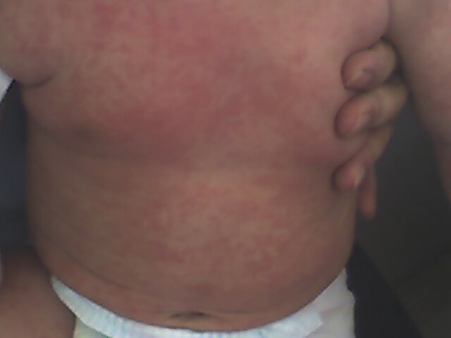 Phát ban: Phát ban không phải lúc nào cũng có nguyên nhân từ dị ứng thực phẩm, đôi khi có thể là vì dị ứng môi trường, thuốc hoặc kết hợp nhiều yếu tố. Tuy nhiên, phát ban là một triệu chứng phổ biến hơn cả khi bị dị ứng thực phẩm. Xem thêm:Điểm danh 12 loại rau, quả dễ nhiễm thuốc trừ sâu hàng đầu 2012 Phát ban: Phát ban không phải lúc nào cũng có nguyên nhân từ dị ứng thực phẩm, đôi khi có thể là vì dị ứng môi trường, thuốc hoặc kết hợp nhiều yếu tố. Tuy nhiên, phát ban là một triệu chứng phổ biến hơn cả khi bị dị ứng thực phẩm. Xem thêm:Điểm danh 12 loại rau, quả dễ nhiễm thuốc trừ sâu hàng đầu 2012