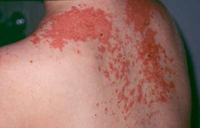 Khi bị nổi mề đay cấp tính cần được cấp cứu ngay. Nếu các triệu chứng tiến triển không ngừng, bạn cần gọi cấp cứu ngay lập tức và thực hiện tất cả các biện pháp cấp cứu cần thiết do bác sĩ yêu cầu. Xem thêm:Điểm danh 12 loại rau, quả dễ nhiễm thuốc trừ sâu hàng đầu 2012 Khi bị nổi mề đay cấp tính cần được cấp cứu ngay. Nếu các triệu chứng tiến triển không ngừng, bạn cần gọi cấp cứu ngay lập tức và thực hiện tất cả các biện pháp cấp cứu cần thiết do bác sĩ yêu cầu. Xem thêm:Điểm danh 12 loại rau, quả dễ nhiễm thuốc trừ sâu hàng đầu 2012