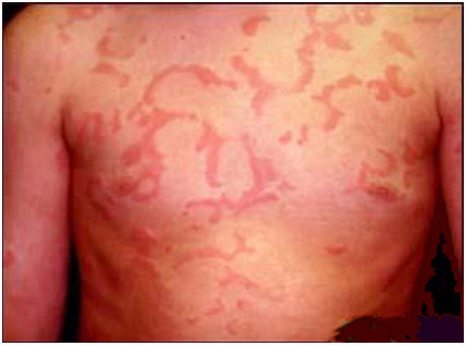 Nổi mề đay cấp tính: Nổi mề đay cấp tính là triệu chứng nghiêm trọng nhất nhưng cũng là triệu chứng dị ứng hiếm gặp và rõ rệt nhất. Xem thêm:Điểm danh 12 loại rau, quả dễ nhiễm thuốc trừ sâu hàng đầu 2012 Nổi mề đay cấp tính: Nổi mề đay cấp tính là triệu chứng nghiêm trọng nhất nhưng cũng là triệu chứng dị ứng hiếm gặp và rõ rệt nhất. Xem thêm:Điểm danh 12 loại rau, quả dễ nhiễm thuốc trừ sâu hàng đầu 2012