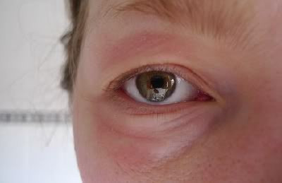 Đôi khi, mọi người lầm tưởng những vết sưng này là vết chắp lẹo, nhưng không như vết chắp lẹo, ban vàng mí mắt thường đi kèm với nhiều vết sưng nhỏ. Xem thêm: Móng tay... nói lên bệnh tật: tim, gan, phổi Đôi khi, mọi người lầm tưởng những vết sưng này là vết chắp lẹo, nhưng không như vết chắp lẹo, ban vàng mí mắt thường đi kèm với nhiều vết sưng nhỏ. Xem thêm: Móng tay... nói lên bệnh tật: tim, gan, phổi