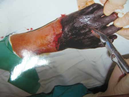 Nước mắm: Có rất nhiều người sau khi bị bỏng đã ngâm ngay vết bỏng vào nước mắm để giữ nhiệt theo cách dân gian, đến khi vào viện vết loét sâu ngấm nước mắm nên thịt thối ra, mùi kinh khủng. Các bác sĩ phải nạo vét lớp thịt hoại tử để cấy ghép da mới. Nhiều người đã phải cắt bỏ tay, chân vì hoại tử sau bỏng. (Trong ảnh: Bàn tay bị hoại tử và phải cắt đi vì bị bỏng rồi ngâm nước mắm). Xem thêm:26 loại thực phẩm giúp bạn ‘thanh lọc’ cơ thể Nước mắm: Có rất nhiều người sau khi bị bỏng đã ngâm ngay vết bỏng vào nước mắm để giữ nhiệt theo cách dân gian, đến khi vào viện vết loét sâu ngấm nước mắm nên thịt thối ra, mùi kinh khủng. Các bác sĩ phải nạo vét lớp thịt hoại tử để cấy ghép da mới. Nhiều người đã phải cắt bỏ tay, chân vì hoại tử sau bỏng. (Trong ảnh: Bàn tay bị hoại tử và phải cắt đi vì bị bỏng rồi ngâm nước mắm). Xem thêm:26 loại thực phẩm giúp bạn ‘thanh lọc’ cơ thể