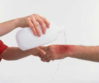 Nên xử lý vết bỏng thế nào? Cần phải phân loại vết bỏng: Vết bỏng thường gây ra do nhiều tác nhân nhưng nguyên nhân chung là do da bị tiếp xúc với những thứ có nhiệt độ cao như dầu mỡ, nước đang sôi, lửa cháy, bô xe máy nóng... Tùy vào nhiệt độ và điều kiện tiếp nhiệt mà các vết bỏng có mức độ nghiêm trọng khác nhau. Thường người ta sẽ chia vết bỏng ra làm 3 cấp độ. Xem thêm:26 loại thực phẩm giúp bạn ‘thanh lọc’ cơ thể Nên xử lý vết bỏng thế nào? Cần phải phân loại vết bỏng: Vết bỏng thường gây ra do nhiều tác nhân nhưng nguyên nhân chung là do da bị tiếp xúc với những thứ có nhiệt độ cao như dầu mỡ, nước đang sôi, lửa cháy, bô xe máy nóng... Tùy vào nhiệt độ và điều kiện tiếp nhiệt mà các vết bỏng có mức độ nghiêm trọng khác nhau. Thường người ta sẽ chia vết bỏng ra làm 3 cấp độ. Xem thêm:26 loại thực phẩm giúp bạn ‘thanh lọc’ cơ thể