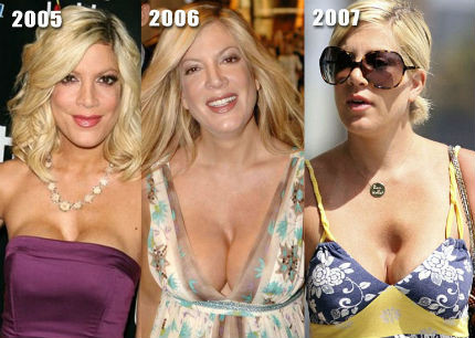 Tori Spelling và sự thay đổi ở vòng 1 sau khi "nâng cấp" Tori Spelling và sự thay đổi ở vòng 1 sau khi "nâng cấp"