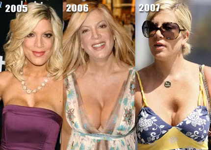 Tori Spelling và sự thay đổi ở vòng 1 sau khi "nâng cấp"