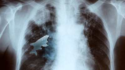 Hình chụp X-quang cho thấy con cá đang "bơi lội" ở lồng ngực Anil. Hình chụp X-quang cho thấy con cá đang "bơi lội" ở lồng ngực Anil.