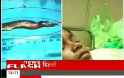 Ca phẫu thuật đã được tiến hành để lôi chú cá bướng bỉnh ra khỏi lồng ngực chú bé. Ca phẫu thuật đã được tiến hành để lôi chú cá bướng bỉnh ra khỏi lồng ngực chú bé.