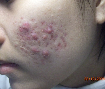 Cảnh giác với mụn nguy hiểm: thứ nhất là mụn mủ: Loại mụn này có phần chân màu đỏ và phần đầu chứa đầy mủ. Nếu thỉnh thoảng bạn bị mụn mủ, bạn có thể thử chữa trị chúng bằng kem hoặc sữa rửa mặt có chứa benzoyl peroxide. Tuy nhiên, nếu bạn thấy mật độ mọc mụn thường xuyên thì hãy đến gặp bác sĩ da liễu ngay và tuyệt đối không nên nặn loại mụn này. (Ảnh chỉ mang tính chất minh họa) Xem thêm: Phóng viên, BTV và MC thường dùng thực phẩm gì để giữ giọng? Cảnh giác với mụn nguy hiểm: thứ nhất là mụn mủ: Loại mụn này có phần chân màu đỏ và phần đầu chứa đầy mủ. Nếu thỉnh thoảng bạn bị mụn mủ, bạn có thể thử chữa trị chúng bằng kem hoặc sữa rửa mặt có chứa benzoyl peroxide. Tuy nhiên, nếu bạn thấy mật độ mọc mụn thường xuyên thì hãy đến gặp bác sĩ da liễu ngay và tuyệt đối không nên nặn loại mụn này. (Ảnh chỉ mang tính chất minh họa) Xem thêm: Phóng viên, BTV và MC thường dùng thực phẩm gì để giữ giọng?