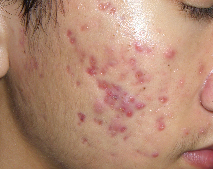 Mụn sẩn: Là những nốt màu đỏ hoặc hồng. Đây là loại mụn nguy hiểm hơn nếu như các bạn "ngứa tay" nặn hoặc kích thích vào chúng. Điều này có thể khiến các nốt sần này sẽ biến thành mụn mủ. Hãy nhớ là bất cứ sự kích ứng nào cũng sẽ làm cho nó trở nên tồi tệ hơn. Còn nếu như các bạn để tự nhiên thì chúng sẽ nhanh chóng tự lành và không để lại sẹo. (Ảnh chỉ mang tính chất minh họa) Xem thêm: Phóng viên, BTV và MC thường dùng thực phẩm gì để giữ giọng? Mụn sẩn: Là những nốt màu đỏ hoặc hồng. Đây là loại mụn nguy hiểm hơn nếu như các bạn "ngứa tay" nặn hoặc kích thích vào chúng. Điều này có thể khiến các nốt sần này sẽ biến thành mụn mủ. Hãy nhớ là bất cứ sự kích ứng nào cũng sẽ làm cho nó trở nên tồi tệ hơn. Còn nếu như các bạn để tự nhiên thì chúng sẽ nhanh chóng tự lành và không để lại sẹo. (Ảnh chỉ mang tính chất minh họa) Xem thêm: Phóng viên, BTV và MC thường dùng thực phẩm gì để giữ giọng?