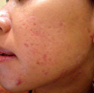 Điều trị mụn đầu trắng cũng không khó, các bạn có thể tự làm và đắp các loại mặt nạ như: bơ , trứng gà và mật ong, bạc hà... để xử lý chúng hiểu quả. Mỗi ngày một lần vào buổi tối, mỗi lần khoảng 15 phút là trên da bạn sẽ hoàn toàn biến mất mụn đầu trắng. (Ảnh chỉ mang tính chất minh họa) Xem thêm: Phóng viên, BTV và MC thường dùng thực phẩm gì để giữ giọng? Điều trị mụn đầu trắng cũng không khó, các bạn có thể tự làm và đắp các loại mặt nạ như: bơ , trứng gà và mật ong, bạc hà... để xử lý chúng hiểu quả. Mỗi ngày một lần vào buổi tối, mỗi lần khoảng 15 phút là trên da bạn sẽ hoàn toàn biến mất mụn đầu trắng. (Ảnh chỉ mang tính chất minh họa) Xem thêm: Phóng viên, BTV và MC thường dùng thực phẩm gì để giữ giọng?