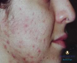 Mụn đầu trắng: Mụn đầu trắng thường nằm dưới da. Các nốt mụn này chứa chất bã nhờn và tế bào chết. Chúng có miệng rất nhỏ nên không khí không thể vào được bên trong. Nhờ vậy mà sự ôxy hóa không diễn ra nên đầu mụn có màu trắng thay vì đen. (Ảnh chỉ mang tính chất minh họa) Xem thêm: Phóng viên, BTV và MC thường dùng thực phẩm gì để giữ giọng? Mụn đầu trắng: Mụn đầu trắng thường nằm dưới da. Các nốt mụn này chứa chất bã nhờn và tế bào chết. Chúng có miệng rất nhỏ nên không khí không thể vào được bên trong. Nhờ vậy mà sự ôxy hóa không diễn ra nên đầu mụn có màu trắng thay vì đen. (Ảnh chỉ mang tính chất minh họa) Xem thêm: Phóng viên, BTV và MC thường dùng thực phẩm gì để giữ giọng?