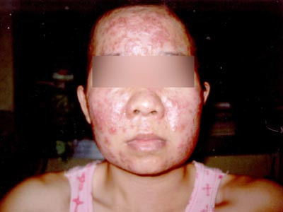 Mụn nang: Mụn nang là những nốt mụn ăn sâu trong da, chứa đầy mủ, gây đau đớn và thường để lại sẹo. Mụn nang có cấu tạo gần giống với mụn bọc. Chúng lan trên bề mặt da và làm tổn thương các tế bào da khỏe mạnh và phá hủy nang lông. (Ảnh chỉ mang tính chất minh họa) Xem thêm: Phóng viên, BTV và MC thường dùng thực phẩm gì để giữ giọng? Mụn nang: Mụn nang là những nốt mụn ăn sâu trong da, chứa đầy mủ, gây đau đớn và thường để lại sẹo. Mụn nang có cấu tạo gần giống với mụn bọc. Chúng lan trên bề mặt da và làm tổn thương các tế bào da khỏe mạnh và phá hủy nang lông. (Ảnh chỉ mang tính chất minh họa) Xem thêm: Phóng viên, BTV và MC thường dùng thực phẩm gì để giữ giọng?