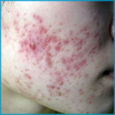 Mụn trứng cá cụm: Trong mụn trứng cá cụm, mô viêm được thành lập quanh nhiều cùi mụn làm nốt mụn ngày càng lớn lên cho đến khi nó tự vỡ và chảy mủ ra. Dưới nốt mụn có thể thành hình chỗ loét sâu gây ra sẹo và các nốt mụn sẽ bám theo ta trong thời gian rất dài. Với loại mụn này chúng ta không thể tự chữa được, mà cần nhanh chóng đến gặp bác sĩ da liễu để tư vấn. (Ảnh chỉ mang tính chất minh họa) Xem thêm: Phóng viên, BTV và MC thường dùng thực phẩm gì để giữ giọng? Mụn trứng cá cụm: Trong mụn trứng cá cụm, mô viêm được thành lập quanh nhiều cùi mụn làm nốt mụn ngày càng lớn lên cho đến khi nó tự vỡ và chảy mủ ra. Dưới nốt mụn có thể thành hình chỗ loét sâu gây ra sẹo và các nốt mụn sẽ bám theo ta trong thời gian rất dài. Với loại mụn này chúng ta không thể tự chữa được, mà cần nhanh chóng đến gặp bác sĩ da liễu để tư vấn. (Ảnh chỉ mang tính chất minh họa) Xem thêm: Phóng viên, BTV và MC thường dùng thực phẩm gì để giữ giọng?