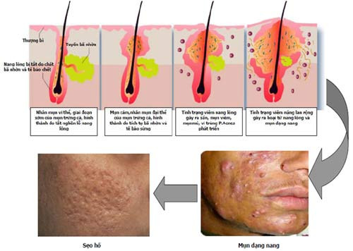 Đây được xem là loại mụn nặng nhất. Để đối phó với mụn nang, chúng ta cần giữ vệ sinh và tốt nhất là đến gặp bác sĩ da liễu để điều trị nếu không trên da sẽ có những vết sẹo do mụn để lại sẽ khiến bạn mất tự tin. (Ảnh chỉ mang tính chất minh họa) Xem thêm: Phóng viên, BTV và MC thường dùng thực phẩm gì để giữ giọng? Đây được xem là loại mụn nặng nhất. Để đối phó với mụn nang, chúng ta cần giữ vệ sinh và tốt nhất là đến gặp bác sĩ da liễu để điều trị nếu không trên da sẽ có những vết sẹo do mụn để lại sẽ khiến bạn mất tự tin. (Ảnh chỉ mang tính chất minh họa) Xem thêm: Phóng viên, BTV và MC thường dùng thực phẩm gì để giữ giọng?