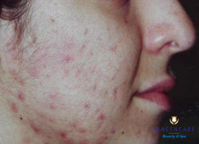 Mụn không nguy hiểm: Loại mụn này bạn có thể tự chữa trị bằng các phương pháp đơn giản. Thậm chí, các chuyên gia còn khuyên "mặc kệ" vì chúng sẽ nhanh chóng lành lặn, trả lại cho bạn một khuôn mặt hoàn hảo. (Ảnh chỉ mang tính chất minh họa) Xem thêm: Phóng viên, BTV và MC thường dùng thực phẩm gì để giữ giọng? Mụn không nguy hiểm: Loại mụn này bạn có thể tự chữa trị bằng các phương pháp đơn giản. Thậm chí, các chuyên gia còn khuyên "mặc kệ" vì chúng sẽ nhanh chóng lành lặn, trả lại cho bạn một khuôn mặt hoàn hảo. (Ảnh chỉ mang tính chất minh họa) Xem thêm: Phóng viên, BTV và MC thường dùng thực phẩm gì để giữ giọng?