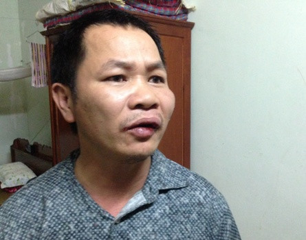 Ông Thức đã bị nhóm lâm tặc tấn công và đánh sưng tấy mặt trong lúc làm nhiệm vụ