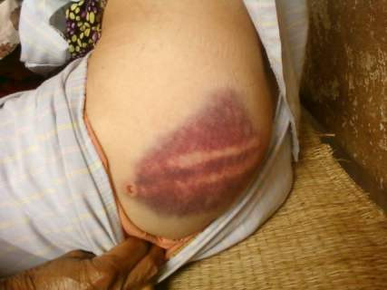 Những vất bầm tím do bị bọn côn đồ đánh đập trên người bà Nguyễn Thị Vân (vợ ông Nam)