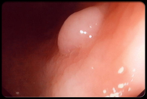 2. Ung thư đại tràng và trực tràng: Ung thư đại tràng là sự tăng trưởng mô của đại tràng, trong khi ung thư trực tràng tăng trưởng ở khoảng 10cm cuối đại tràng gần hậu môn. Phần lớn các trường hợp bắt đầu là khối tế bào nhỏ, lành tính (gọi là polyp), theo thời gian tiến triển thành ung thư. Theo Bệnh viện Mayo Clinic, nên khuyến nghị sàng lọc để phát hiện polyp trước khi chúng trở thành ung thư. Năm 2010, ung thư đại trực tràng khiến hơn 51.000 người tử vong.