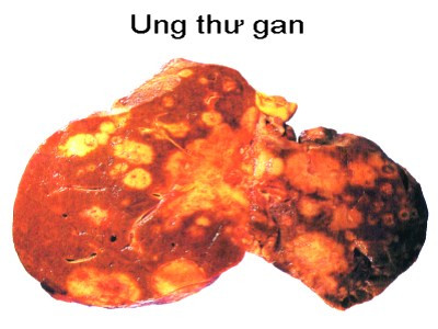 8. Ung thư gan và ống mật trong gan: Ung thư gan là một trong những bệnh ung thư phổ biến nhất trên thế giới, nhưng không hay gặp ở Mỹ. Tuy nhiên, tỷ lệ ung thư gan ở Mỹ đang gia tăng. Phần lớn ung thư gan xuất hiện ở Mỹ bắt nguồn từ vị trí khác sau đó di căn tới gan. Loại ung thư tương đối gần là ung thư ống mật trong gan, xuất hiện trong ống dẫn mật từ gan tới ruột non. Theo NCI, nam 2010 có gần 19.000 người Mỹ tử vong vì ung thư gan và ống mật trong gan.