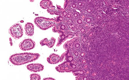 Có một vài thể bệnh lympho không Hodgkin, được phân loại theo ung thư phát triển nhanh hay chậm và loại tế bào lympho bị tác động. Bệnh lympho không Hodgkin dễ chết người hơn bệnh lympho Hodgkin, và gây tử vong cho hơn 20.000 người trong năm 2010.