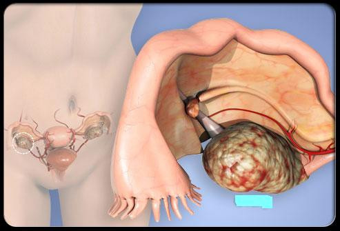 9. Ung thư buồng trứng: NCI cho biết ung thư buồng trứng là nguyên nhân gây tử vong đứng hàng thứ 4 ở phụ nữ trong khoảng thời gian 2003-2007. Tuổi trung bình của phụ nữ khi được chẩn đoán bệnh là 63. Căn bệnh này dễ điều trị hơn nhưng khó phát hiện ở các giai đoạn đầu. Các triệu chứng bao gồm khó chịu ở bụng, tiểu gấp và đau vùng tiểu khung. Theo NCI, năm 2010 có gần 14.000 phụ nữ tử vong do ung thư buồng trứng.