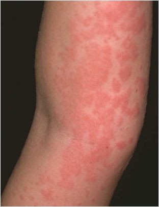 5. Phát ban trên da: Phát ban trên da có thể xảy ra ở giai đoạn sớm hoặc muộn của bệnh. Các vết sưng, hồng, ngứa trên da nếu không có lý do thỏa đáng, bạn nên nghĩ tới xét nghiệm HIV. 5. Phát ban trên da: Phát ban trên da có thể xảy ra ở giai đoạn sớm hoặc muộn của bệnh. Các vết sưng, hồng, ngứa trên da nếu không có lý do thỏa đáng, bạn nên nghĩ tới xét nghiệm HIV.