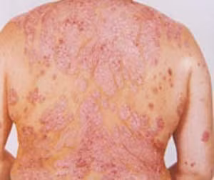 12. Bệnh nấm: Một loại bệnh nấm khác người có HIV hay gặp ở giai đoạn muộn là bệnh tưa miệng - do nấm Candida gây ra, thường gây khó nuốt.