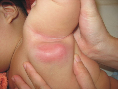 Những dấu hiệu sờ thấy hoặc nhìn thấy: Một số dấu hiệu báo động có thể nhìn thấy hoặc sờ thấy được. Nếu sờ thấy một cục nhỏ hoặc một vùng cứng bất thường ở da, cơ, vú hoặc tinh hoàn mà những tổn thương vùng này lại tồn tại lâu hoặc to lên đều đặn thì dù chúng có đau hay không cũng cần phải đi khám bệnh ngay.