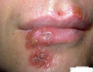 Các vết loét mãn tính trên da và trong niêm mạc miệng, môi, bộ phận sinh dục, hay xuất hiện một số dấu hiệu đặc biệt như sự phân bổ bất thường của các sắc tố da, đường mờ phân cách giữa các vết và vùng da khỏe mạnh, chảy máu và rỉ máu.