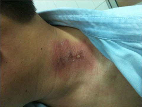 Da nổi gồ lên không đều, bị loét lâu không liền và lan rộng cũng là dấu hiệu báo động của ung thư da. Cuối cùng, nếu thấy hột mụn cơm (mụn cóc) hoặc nốt ruồi dày lên, thay đổi màu sắc hoặc chảy máu cũng phải đến gặp thầy thuốc ngay.