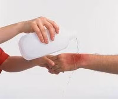 Sơ cứu khi bị côn trùng đốt. Ảnh minh họa. Sơ cứu khi bị côn trùng đốt. Ảnh minh họa.