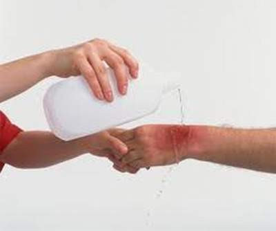 Sơ cứu khi bị côn trùng đốt. Ảnh minh họa. Sơ cứu khi bị côn trùng đốt. Ảnh minh họa.