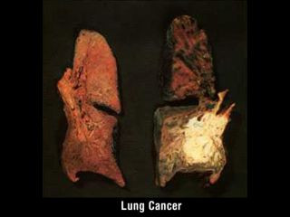 Hút thuốc lá là nguyên nhân trực tiếp dẫn đến bệnh ung thư miệng và họng. Người hút thuốc lá chắc chắn sẽ chết sớm hơn do các bệnh mạch vành. Họ thường xuyên đau thắt ngực do những cơn thiếu máu cơ tim, nghĩa là những lúc giảm thời lượng máu đến nuôi cơ tim. Nguy cơ nhồi máu cơ tim xảy ra nhiều hơn ở người hút thuốc. Họ cũng dễ bị đột quỵ hơn người bình thường, ngoài ra người hút thuốc lá nhiều cũng dễ bị loét dạ dày và hành tá tràng.