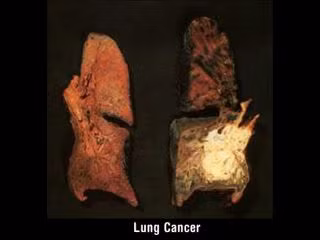 Hút thuốc lá là nguyên nhân trực tiếp dẫn đến bệnh ung thư miệng và họng. Người hút thuốc lá chắc chắn sẽ chết sớm hơn do các bệnh mạch vành. Họ thường xuyên đau thắt ngực do những cơn thiếu máu cơ tim, nghĩa là những lúc giảm thời lượng máu đến nuôi cơ tim. Nguy cơ nhồi máu cơ tim xảy ra nhiều hơn ở người hút thuốc. Họ cũng dễ bị đột quỵ hơn người bình thường, ngoài ra người hút thuốc lá nhiều cũng dễ bị loét dạ dày và hành tá tràng.