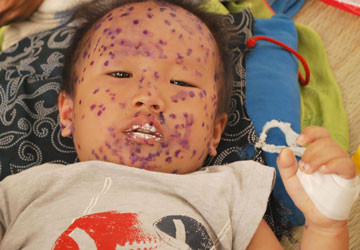 Đồ chơi, vật dụng trẻ hay cầm nắm của trẻ cần được thường xuyên rửa sạch với xà phòng, dung dịch diệt khuẩn, phơi khô.