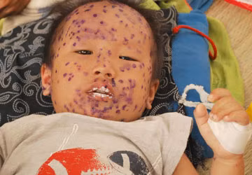 Đồ chơi, vật dụng trẻ hay cầm nắm của trẻ cần được thường xuyên rửa sạch với xà phòng, dung dịch diệt khuẩn, phơi khô.