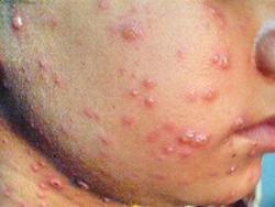 Bệnh Tay – Chân – Miệng xảy ra chủ yếu ở trẻ em dưới 10 tuổi tuy nhiên cũng có thể gặp ở cả người trưởng thành. Mọi người đều có thể nhiễm virus nhưng không phải tất cả những người nhiễm virus đều biểu hiện bệnh.