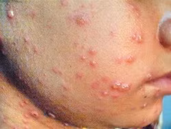 Bệnh Tay – Chân – Miệng xảy ra chủ yếu ở trẻ em dưới 10 tuổi tuy nhiên cũng có thể gặp ở cả người trưởng thành. Mọi người đều có thể nhiễm virus nhưng không phải tất cả những người nhiễm virus đều biểu hiện bệnh.