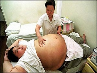 Bệnh béo phì còn là nguyên nhân dẫn đến bệnh loãng xương khi về già Bệnh béo phì còn là nguyên nhân dẫn đến bệnh loãng xương khi về già