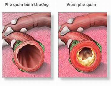 Viêm phế quản cấp: Ho là triệu chứng chủ yếu thường gặp, lúc đầu trẻ bị ho khan, ho từng cơn và thường ho vào ban đêm, sau đó có sốt nhẹ, trẻ lớn có thể thấy đau ngực. Bệnh viêm phế quản cấp là bệnh nhẹ nhưng hay mắc phải, đa số bệnh khỏi sau một tuần bệnh có thể tái phát và có biến chứng như viêm phổi, viêm tai giữa. (Ảnh: ITN) Xem thêm: Chùm ảnh: Sự nguy hiểm của việc sâu răng ở trẻ