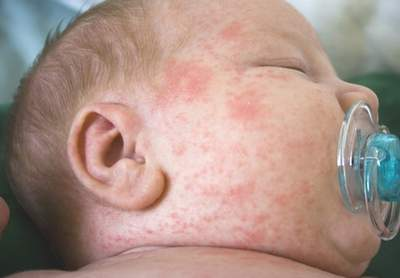Rôm sảy: Thường xảy ra đối với trẻ nhỏ dưới 3 tuổi, nguyên nhân do khi cơ thể trẻ quá nóng, da sẽ phản ứng lại bằng cách tiết ra nhiều mồ hôi và mọc rôm sảy. Việc dùng tã lót cho trẻ một cách thiếu cẩn thận, không thay mới thường xuyên cũng có thể khiến trẻ bị rôm.(Ảnh: ITN) Xem thêm: Chùm ảnh: Sự nguy hiểm của việc sâu răng ở trẻ
