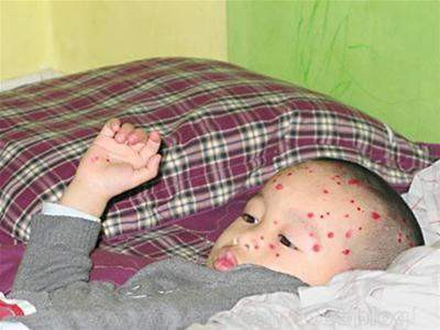 Nếu trẻ có dấu hiệu sốt trong những ngày nốt thủy dậu xuất hiện và lan rộng thì phải đưa con đi bác sĩ ngay lập tắc, nếu không sẽ rất nguy hiểm.(Ảnh: ITN) Xem thêm: Chùm ảnh: Sự nguy hiểm của việc sâu răng ở trẻ