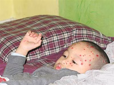 Nếu trẻ có dấu hiệu sốt trong những ngày nốt thủy dậu xuất hiện và lan rộng thì phải đưa con đi bác sĩ ngay lập tắc, nếu không sẽ rất nguy hiểm.(Ảnh: ITN) Xem thêm: Chùm ảnh: Sự nguy hiểm của việc sâu răng ở trẻ