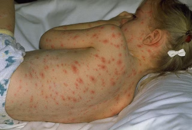 Bệnh thủy đậu: Thủy đậu là bệnh do virus gây ra. Trẻ bị thủy đậu trước tiên sẽ có triệu chứng ngây ngấy sốt, sau có thể sốt cao. Bệnh có thể kéo dài 4-5 ngày.(Ảnh: ITN) Xem thêm: Chùm ảnh: Sự nguy hiểm của việc sâu răng ở trẻ