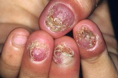 Trường hợp nấm móng điển hình.