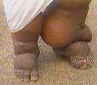 Bệnh có hai thể cấp tính và mạn tính. Bệnh cấp tính có các triệu chứng: sốt, có thể có viêm hạch bạch huyết; dấu hiệu đặc trưng là viêm hạch lympho kiểu lan truyền ngược dòng từ hạch bị viêm; bệnh tiến triển, gây viêm mào tinh hoàn và tinh hoàn, viêm mạch lympho vùng chậu, bụng… Bệnh có hai thể cấp tính và mạn tính. Bệnh cấp tính có các triệu chứng: sốt, có thể có viêm hạch bạch huyết; dấu hiệu đặc trưng là viêm hạch lympho kiểu lan truyền ngược dòng từ hạch bị viêm; bệnh tiến triển, gây viêm mào tinh hoàn và tinh hoàn, viêm mạch lympho vùng chậu, bụng…