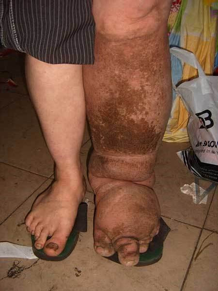 Rửa sạch sẽ vùng bị tổn thương bằng nước và xà phòng mỗi ngày. Một số nghiên cứu cho thấy, thói quen này có thể làm giảm một cách hiệu quả các triệu chứng của bệnh. Điều này cho thấy, rất nhiều triệu chứng không liên quan trực tiếp tới giun chỉ bạch huyết mà là biểu hiện của các bệnh nhiễm trùng thứ phát do vi khuẩn gây ra. Rửa sạch sẽ vùng bị tổn thương bằng nước và xà phòng mỗi ngày. Một số nghiên cứu cho thấy, thói quen này có thể làm giảm một cách hiệu quả các triệu chứng của bệnh. Điều này cho thấy, rất nhiều triệu chứng không liên quan trực tiếp tới giun chỉ bạch huyết mà là biểu hiện của các bệnh nhiễm trùng thứ phát do vi khuẩn gây ra.