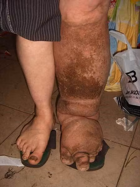 Rửa sạch sẽ vùng bị tổn thương bằng nước và xà phòng mỗi ngày. Một số nghiên cứu cho thấy, thói quen này có thể làm giảm một cách hiệu quả các triệu chứng của bệnh. Điều này cho thấy, rất nhiều triệu chứng không liên quan trực tiếp tới giun chỉ bạch huyết mà là biểu hiện của các bệnh nhiễm trùng thứ phát do vi khuẩn gây ra.