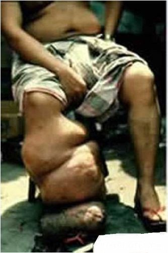 Ở bệnh nhân mạn tính là các triệu chứng: tắc mạch với biểu hiện ứ nước tinh hoàn, phù tinh hoàn, giãn mạch bạch huyết nhất là ở các chi, bộ phận sinh dục, vú và bị tật chân voi… Ở bệnh nhân mạn tính là các triệu chứng: tắc mạch với biểu hiện ứ nước tinh hoàn, phù tinh hoàn, giãn mạch bạch huyết nhất là ở các chi, bộ phận sinh dục, vú và bị tật chân voi…